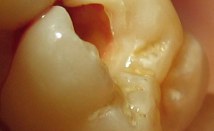Fillings