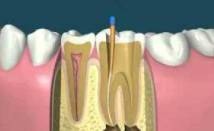 Root Canal Treatment